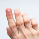 Leukonychia: taches blanches sur les ongles.